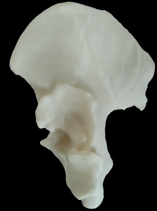 Caso 1 - imagen 2 (planificación 3D y cirugía de cadera)