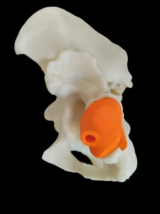 Caso 1 - imagen 3 (planificación 3D y cirugía de cadera)