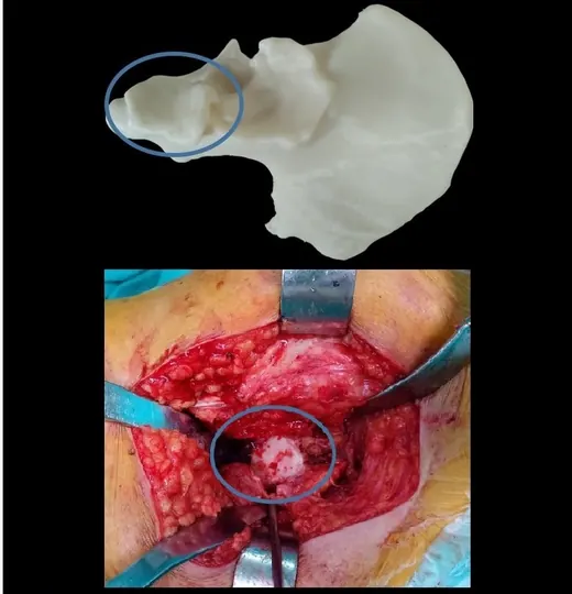 Caso 1 - imagen 4 (planificación 3D y cirugía de cadera)