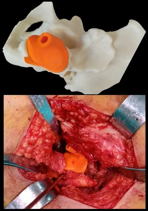 Caso 1 - imagen 5 (planificación 3D y cirugía de cadera)