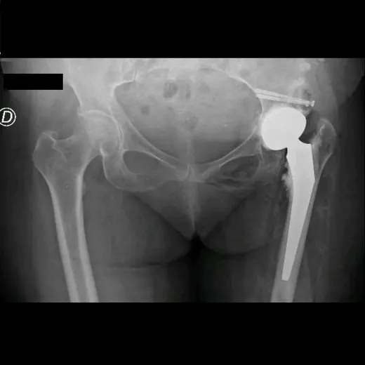 Caso 1 - imagen 7 (planificación 3D y cirugía de cadera)