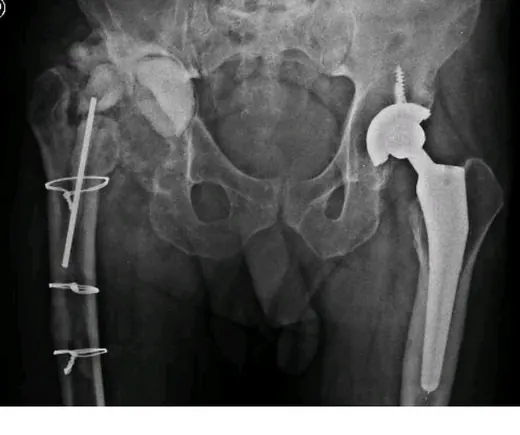 Caso 2 - imagen 2 (planificación 3D y cirugía de cadera)