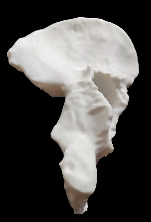 Caso 2 - imagen 4 (planificación 3D y cirugía de cadera)