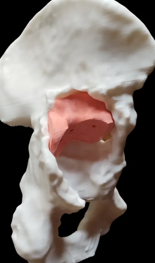 Caso 2 - imagen 5 (planificación 3D y cirugía de cadera)