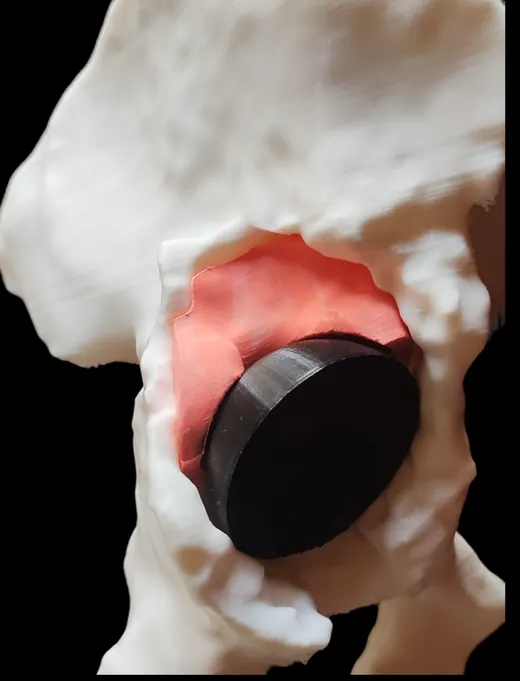 Caso 2 - imagen 6 (planificación 3D y cirugía de cadera)