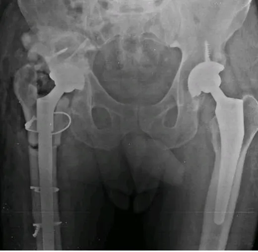 Caso 2 - imagen 7 (planificación 3D y cirugía de cadera)