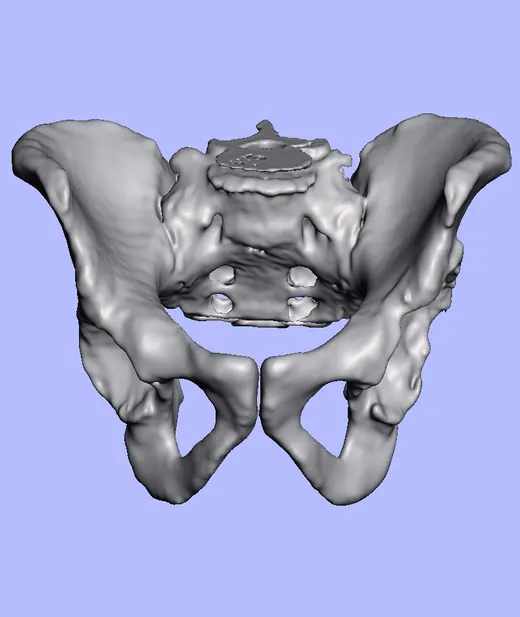 Caso 3 - imagen 2 (planificación 3D y cirugía de cadera)