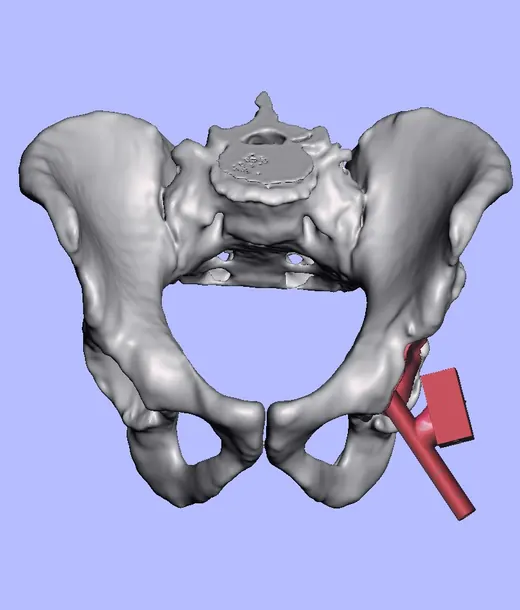 Caso 3 - imagen 3 (planificación 3D y cirugía de cadera)