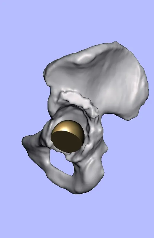Caso 3 - imagen 4 (planificación 3D y cirugía de cadera)
