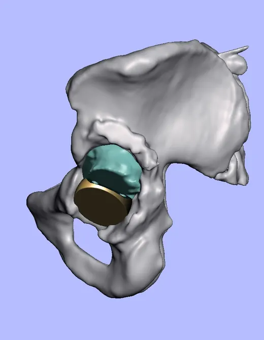 Caso 3 - imagen 6 (planificación 3D y cirugía de cadera)