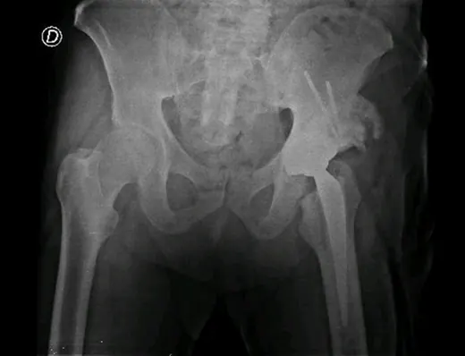 Caso 3 - imagen 7 (planificación 3D y cirugía de cadera)