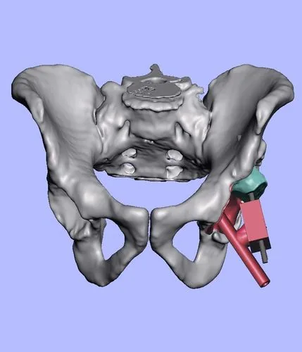Planificación digital 3D de pelvis con implante y vástago