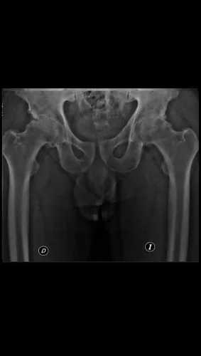 Caso bilateral 1: Rx preoperatoria con artrosis bilateral de cadera