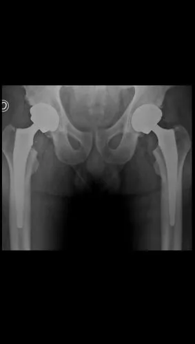 Caso bilateral 1: Rx postoperatoria con prótesis bilateral de cadera