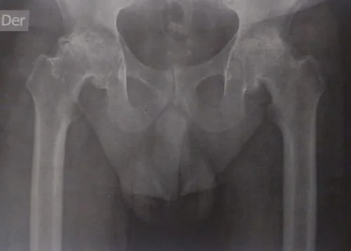Caso bilateral 2: Rx preoperatoria con artrosis bilateral de cadera