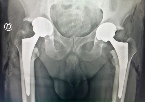 Caso bilateral 2: Rx postoperatoria con prótesis bilateral de cadera