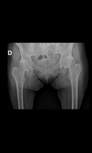 Caso bilateral 3: Rx preoperatoria con artrosis bilateral de cadera