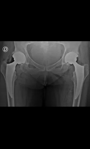 Caso bilateral 3: Rx postoperatoria con prótesis bilateral y tallo acortado