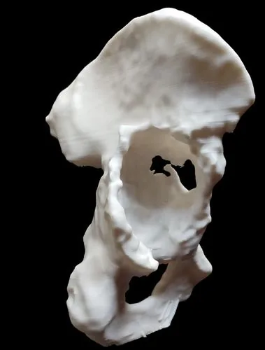 Biomodelo 3D impreso de hemipelvis con defecto acetabular