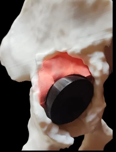 Biomodelo 3D con guía de defecto y cotilo impreso