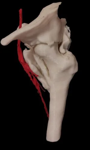 Biomodelo 3D impreso de fémur con trazado de fractura