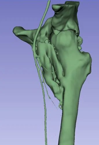 Software de segmentación 3D para planificación de cadera