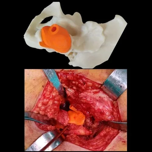 Biomodelo 3D con guía acetabular vs correlación intraoperatoria