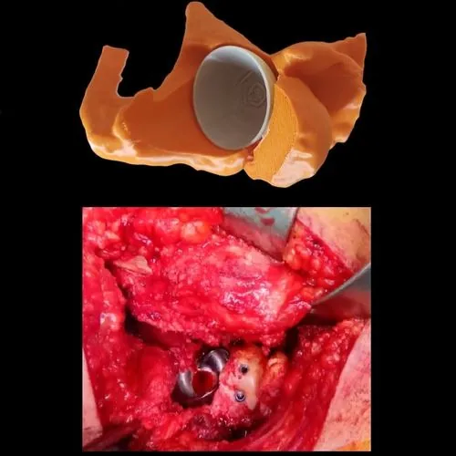 Copa acetabular en biomodelo 3D vs implante real