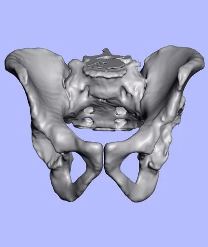 Modelo digital 3D de pelvis para planificación quirúrgica
